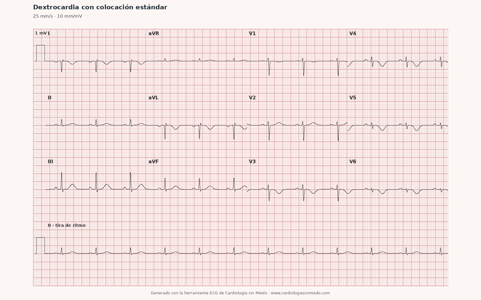 ECG de dextrocardia registrado con los electrodos en la colocación estándar izquierda