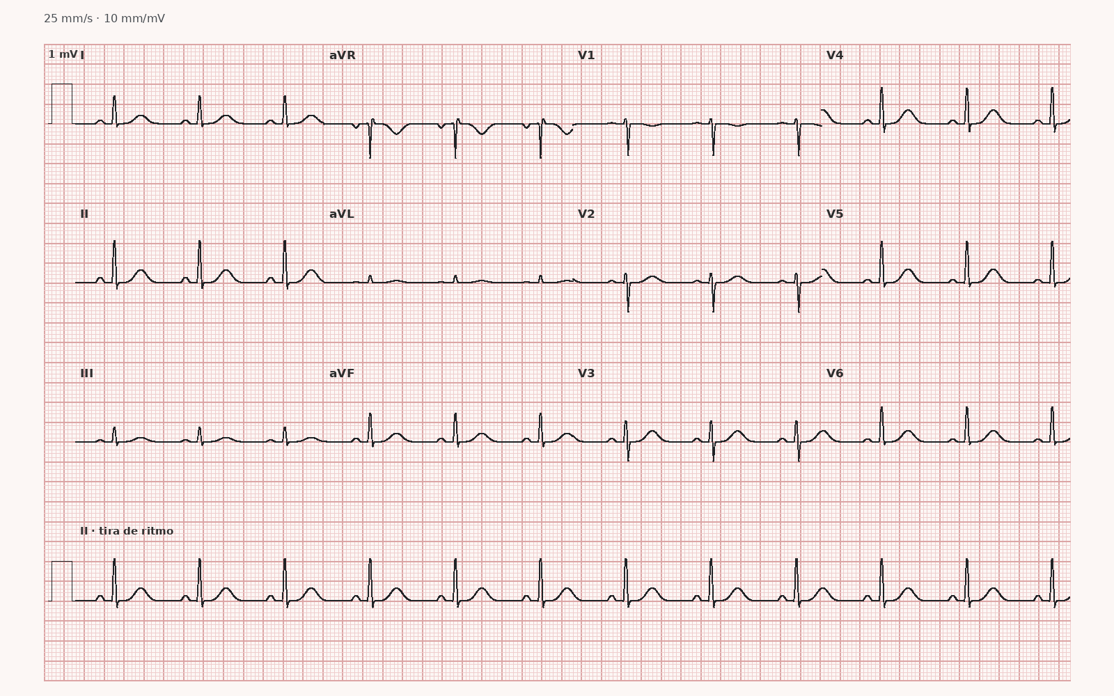 Ritmo sinusal en el ECG: qué significa y cómo reconocerlo