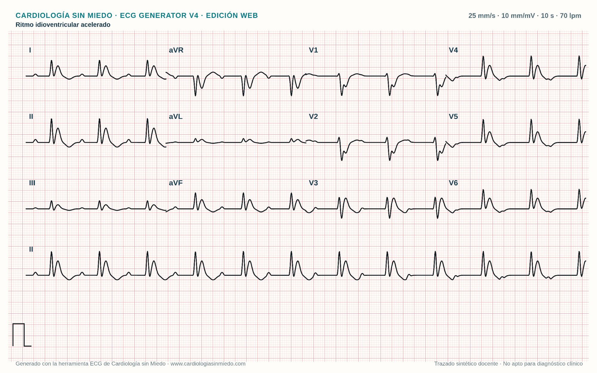 ECG de 12 derivaciones con ritmo idioventricular acelerado (RIVA), QRS anchos y ritmo ventricular cercano a la frecuencia sinusal