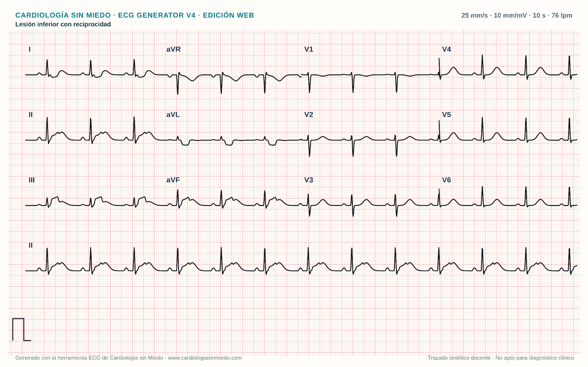 ECG de 12 derivaciones con elevación del ST en II III y aVF y descenso recíproco en I y aVL
