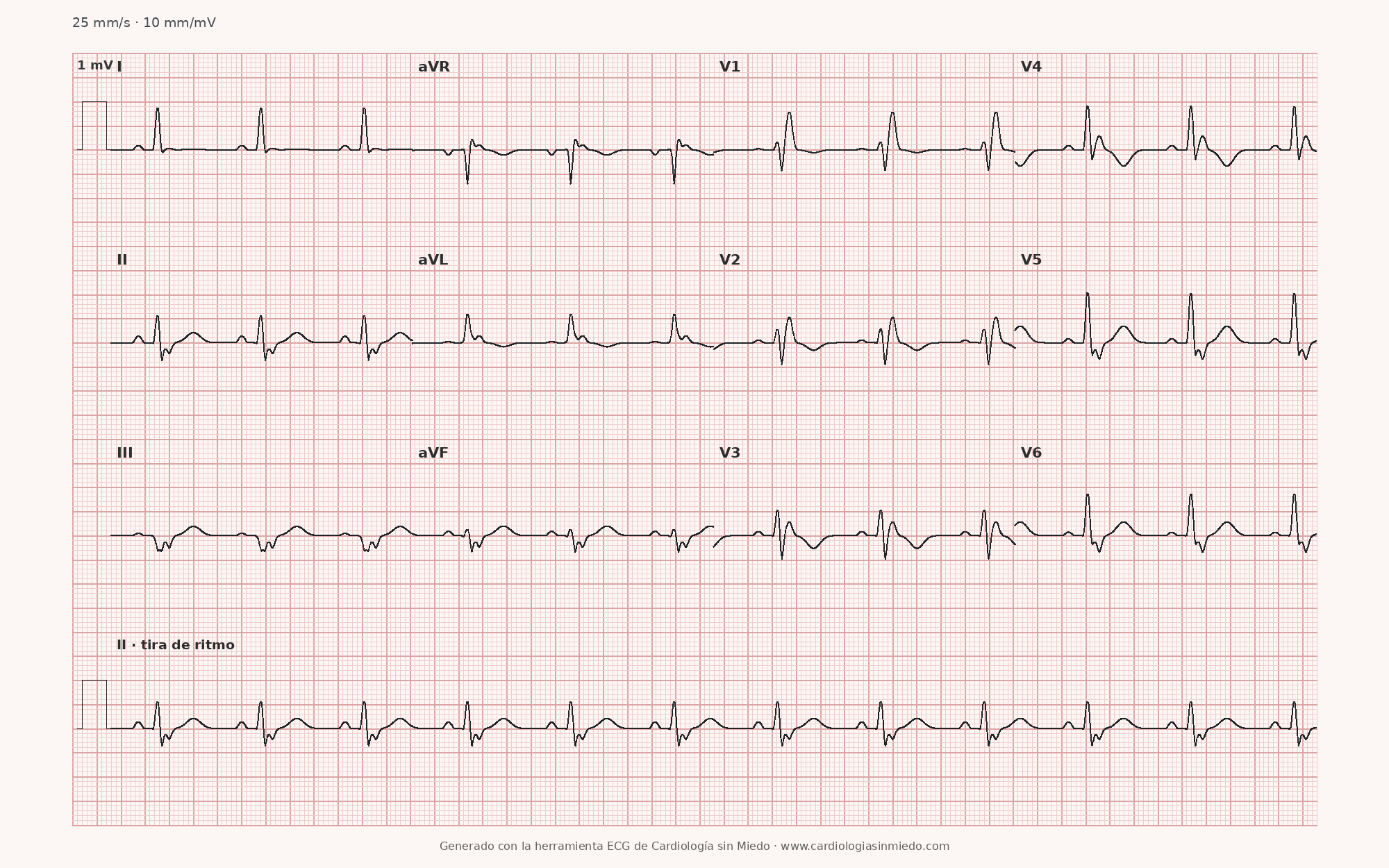 ECG de 12 derivaciones con bloqueo bifascicular, bloqueo de rama derecha y hemibloqueo anterior izquierdo