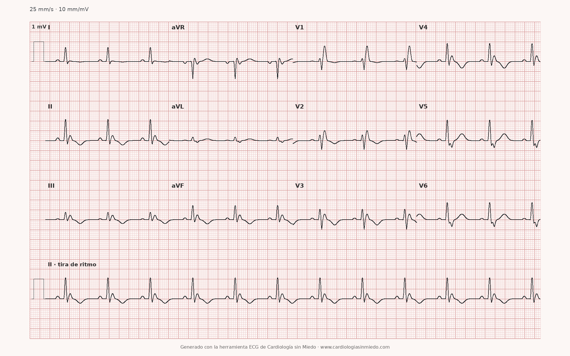 Bloqueo de rama derecha en el ECG: criterios y cómo reconocerlo