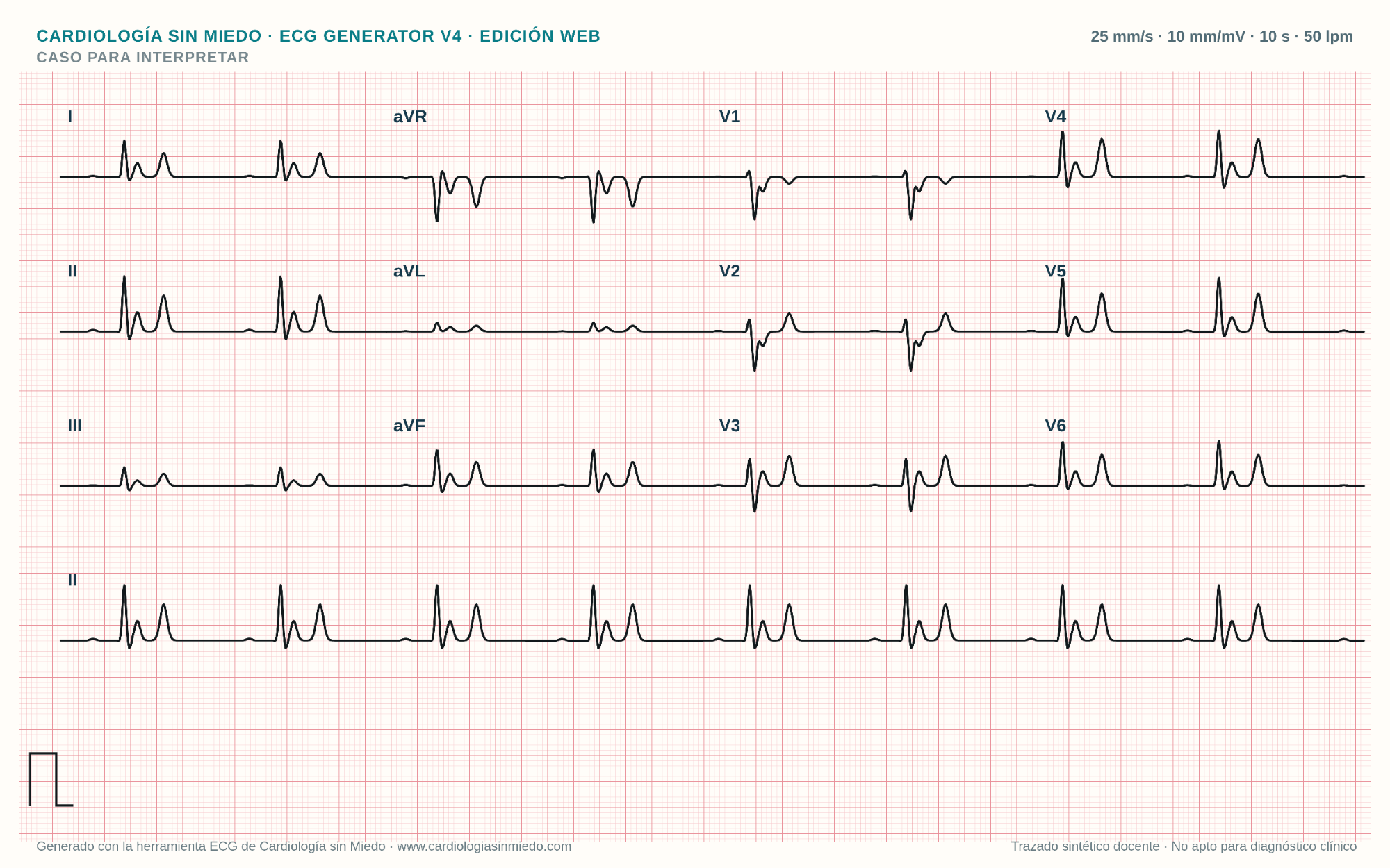 ECG de 12 derivaciones con ritmo sinusal bradicárdico, PR prolongado, QRS ensanchado y ondas T altas y picudas