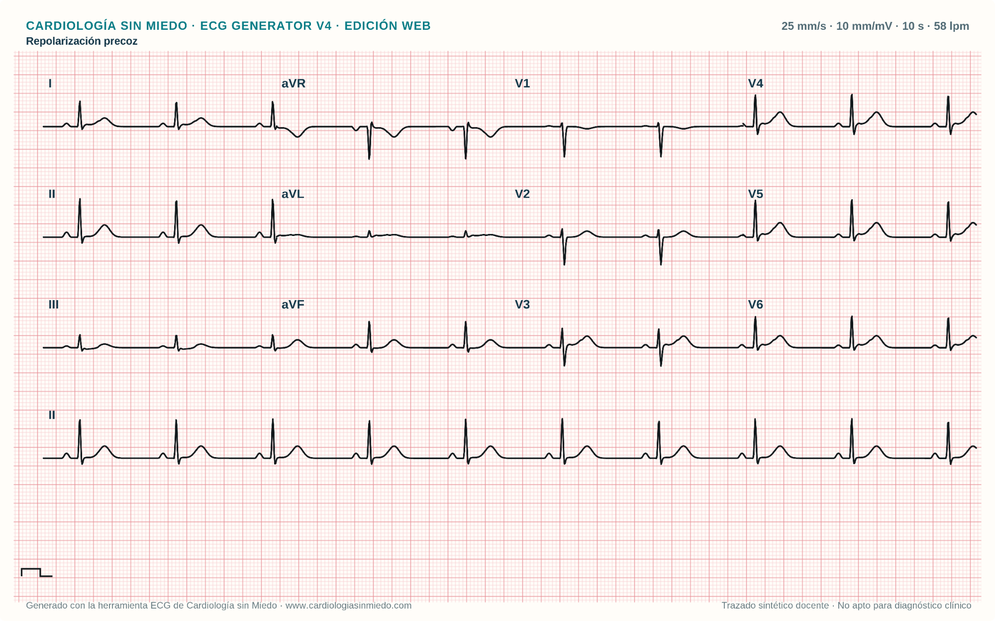 Repolarización precoz en el ECG: cómo reconocerla y diferenciarla de infarto y pericarditis