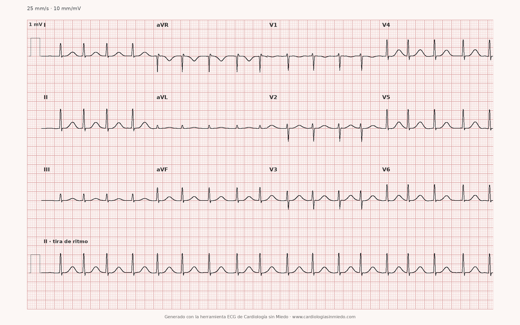 ECG de 12 derivaciones con fibrilación auricular, intervalos RR irregularmente irregulares y sin ondas P organizadas