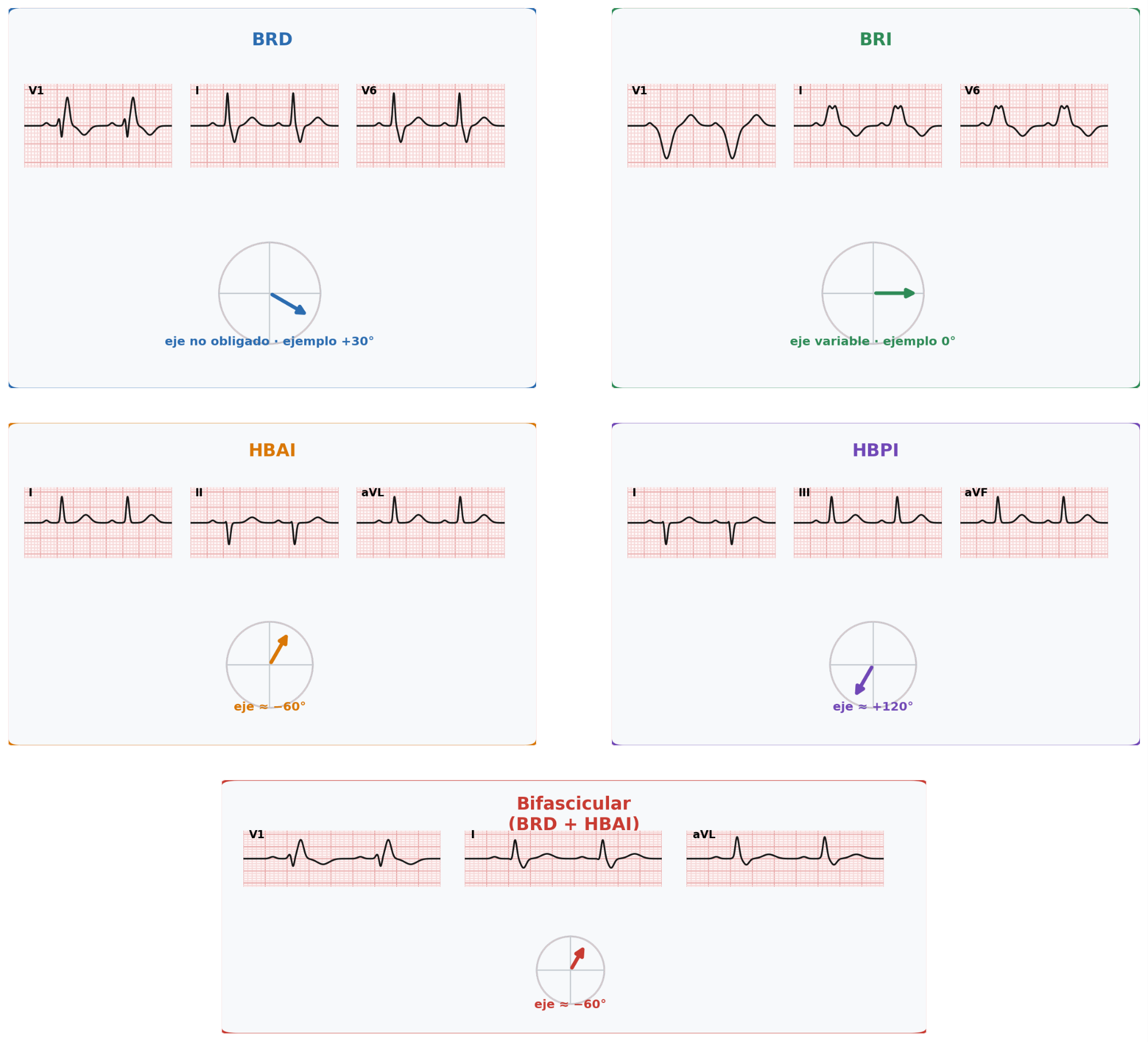 Comparación de bloqueo de rama derecha, bloqueo de rama izquierda, hemibloqueo anterior izquierdo, hemibloqueo posterior izquierdo y bloqueo bifascicular en el ECG