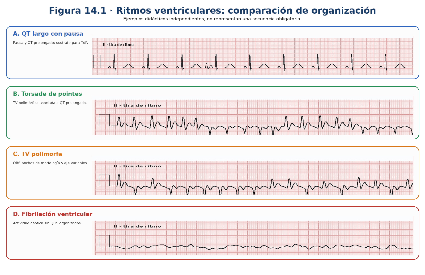 Comparación de QT prolongado con pausa, torsade de pointes, taquicardia ventricular polimórfica y fibrilación ventricular