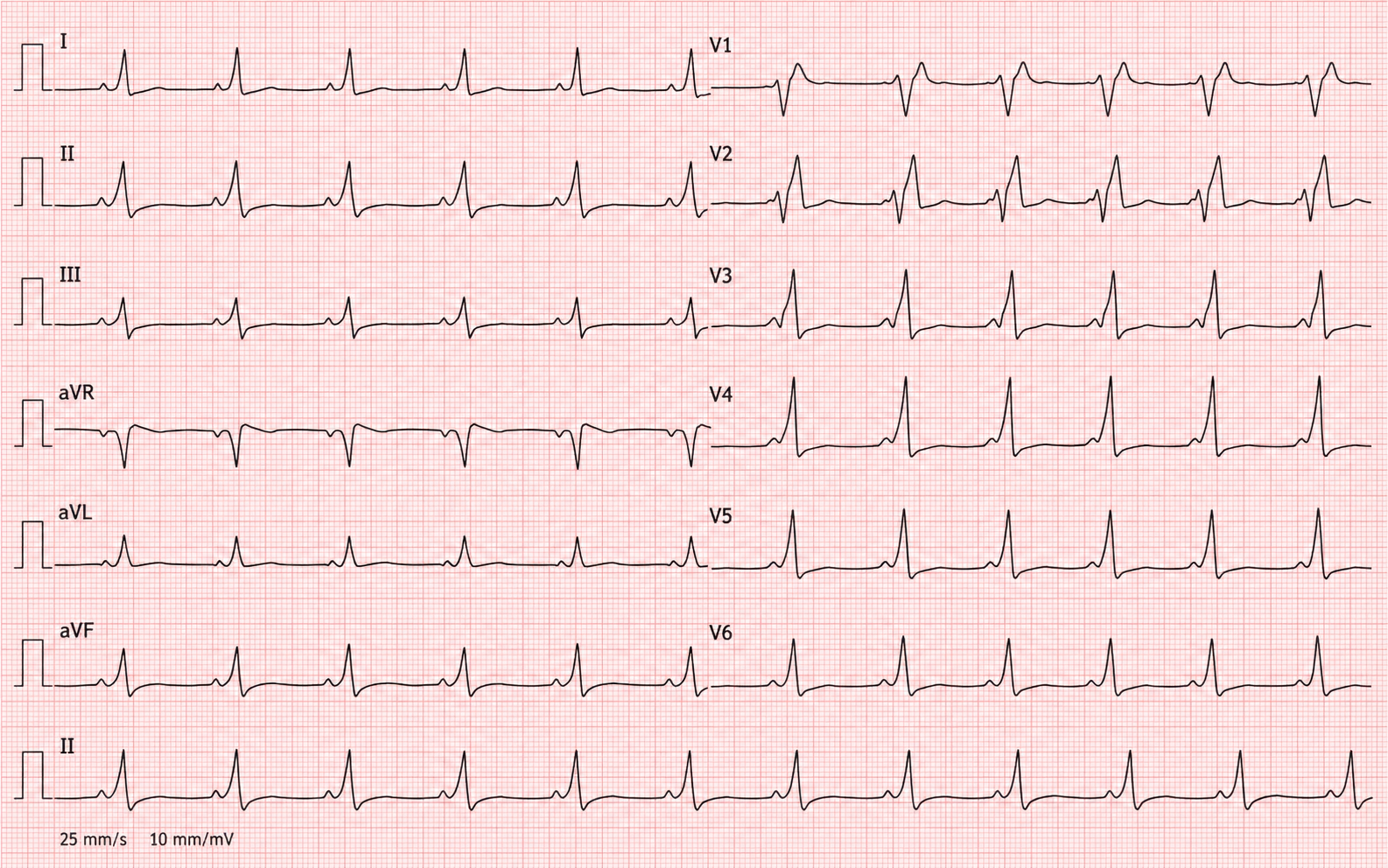 ECG de 12 derivaciones con PR corto, inicio empastado del QRS compatible con onda delta y QRS ensanchado, patrón docente de preexcitación ventricular