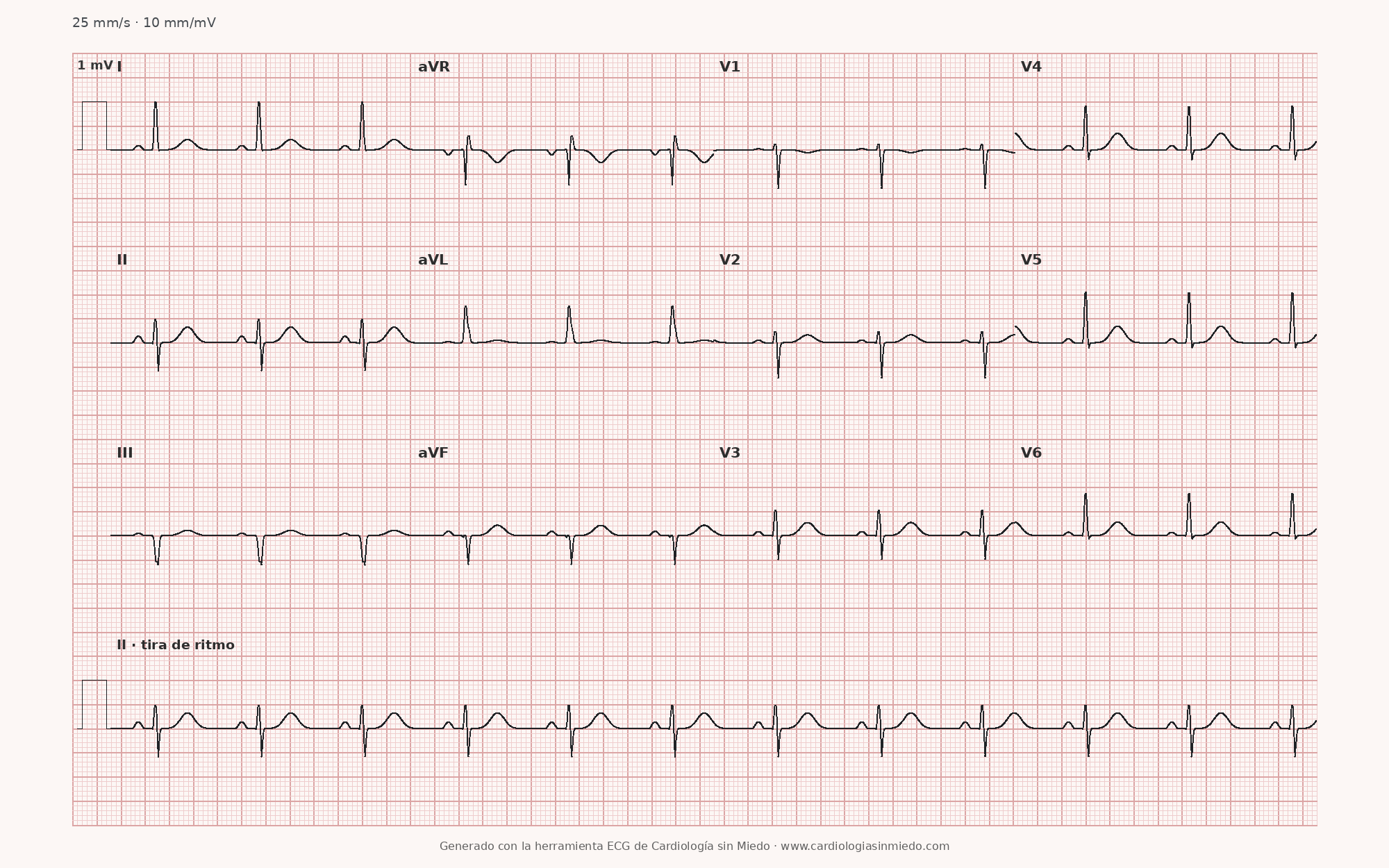 Hemibloqueo anterior izquierdo (HBAI) en el ECG: criterios y cómo reconocerlo