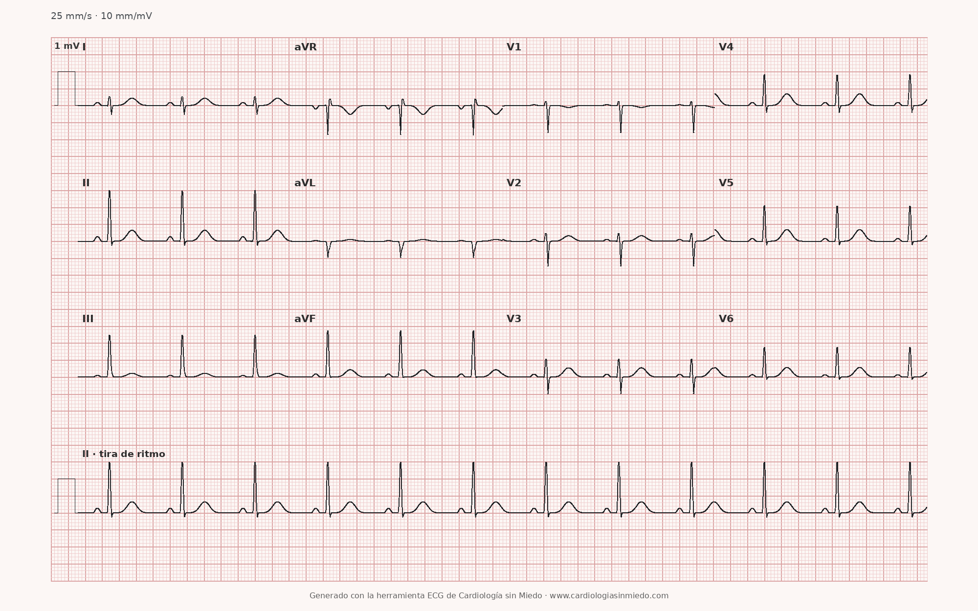 ECG de 12 derivaciones con hemibloqueo posterior izquierdo, eje desviado a la derecha, rS en I y aVL y qR en derivaciones inferiores