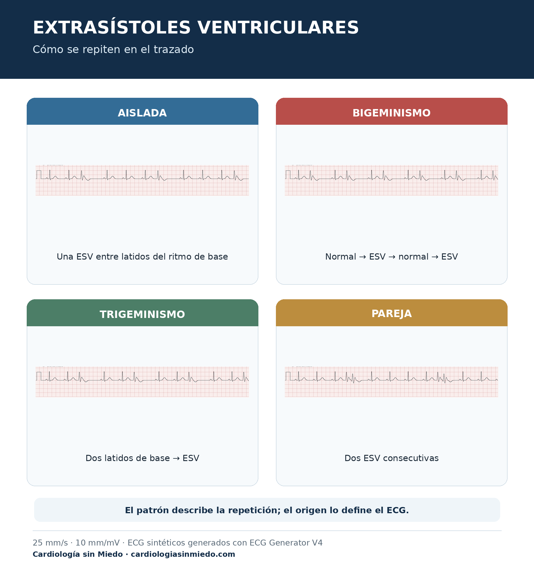 Infografía de extrasístoles ventriculares con patrones unifocales, multifocales, bigeminismo y trigeminismo