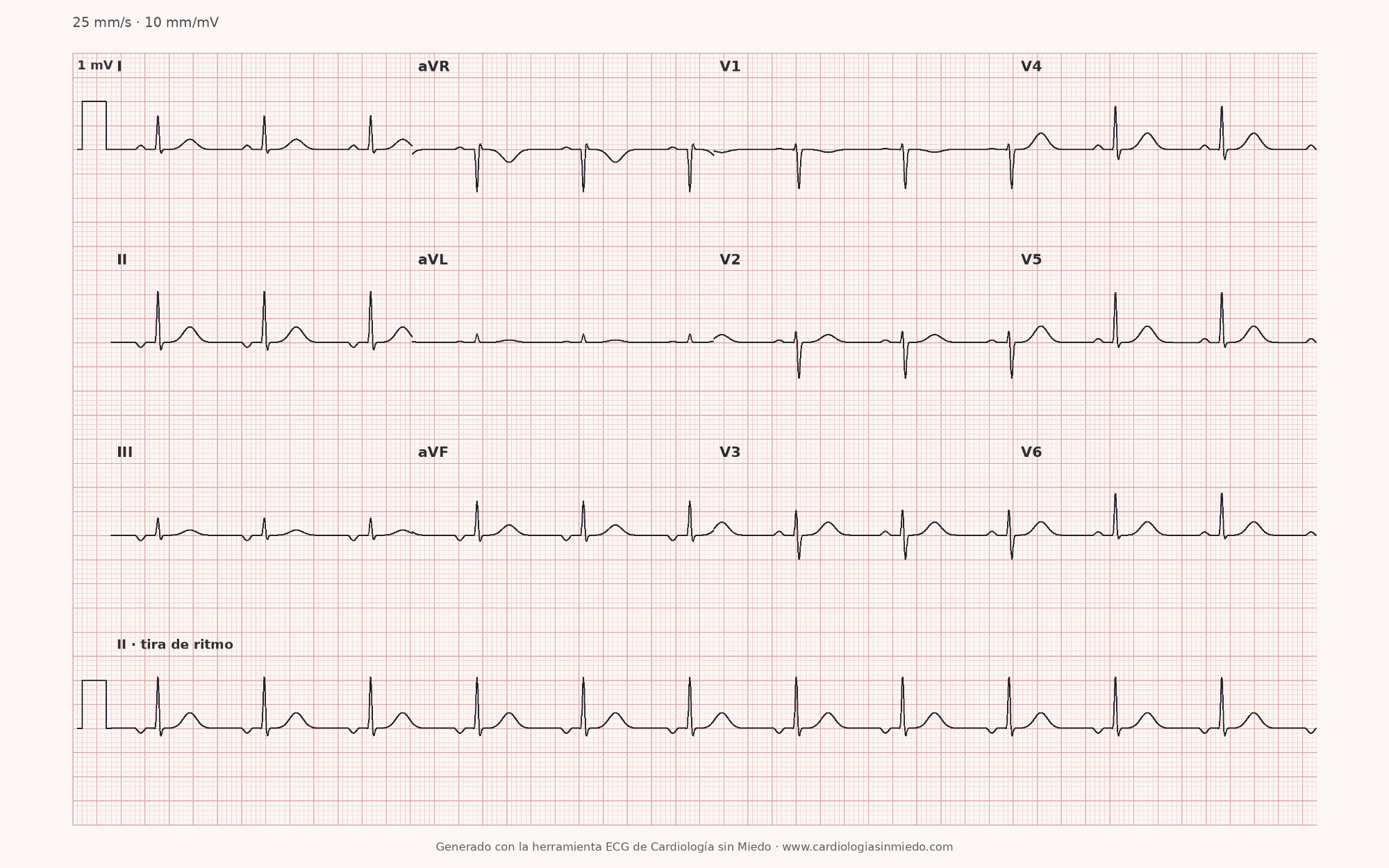 ECG para practicar: ondas P negativas en II, III y aVF con QRS estrecho