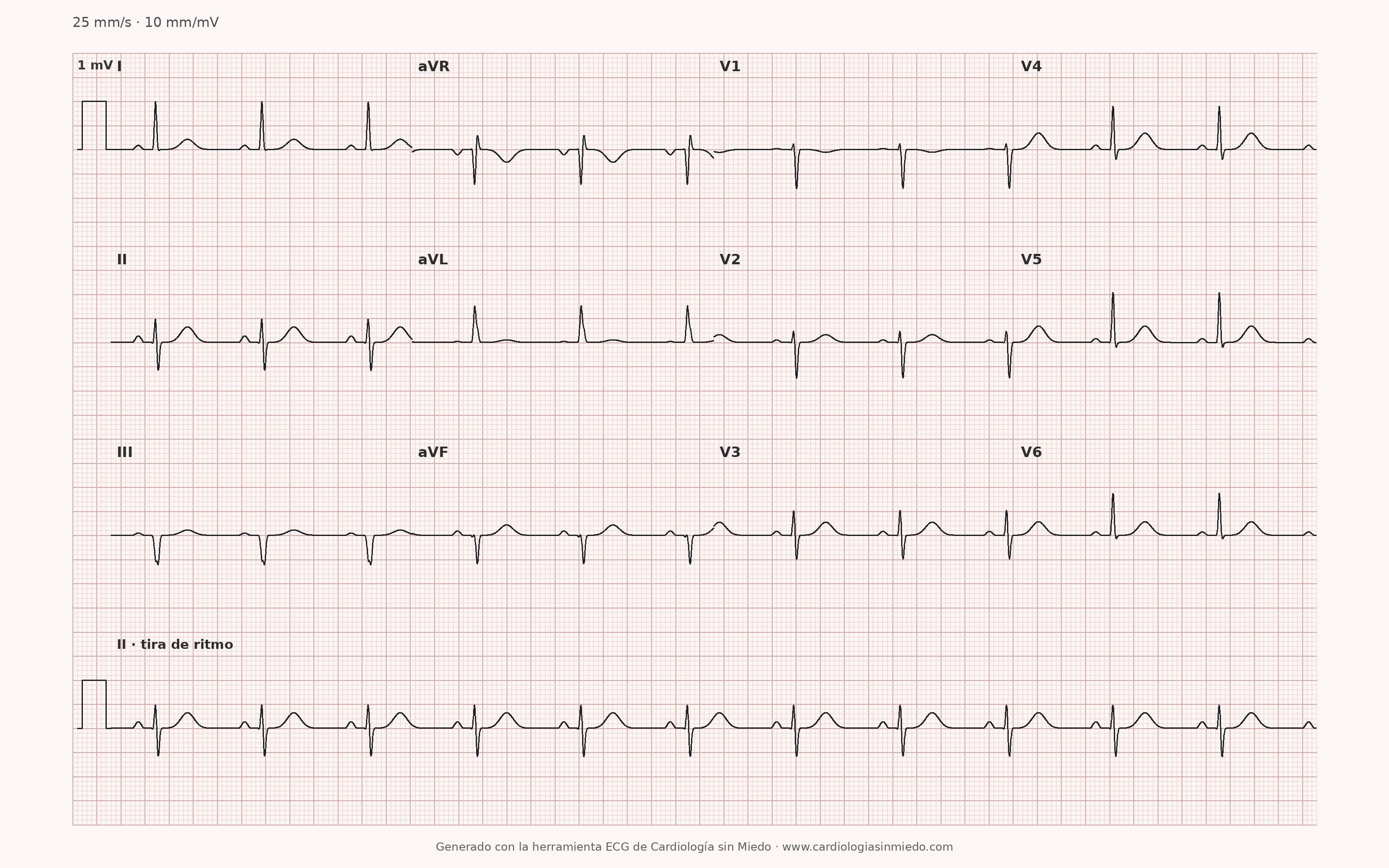 ECG de 12 derivaciones del caso semanal con ritmo sinusal, QRS estrecho y desviación izquierda del eje, generado con el motor de Cardiología sin Miedo