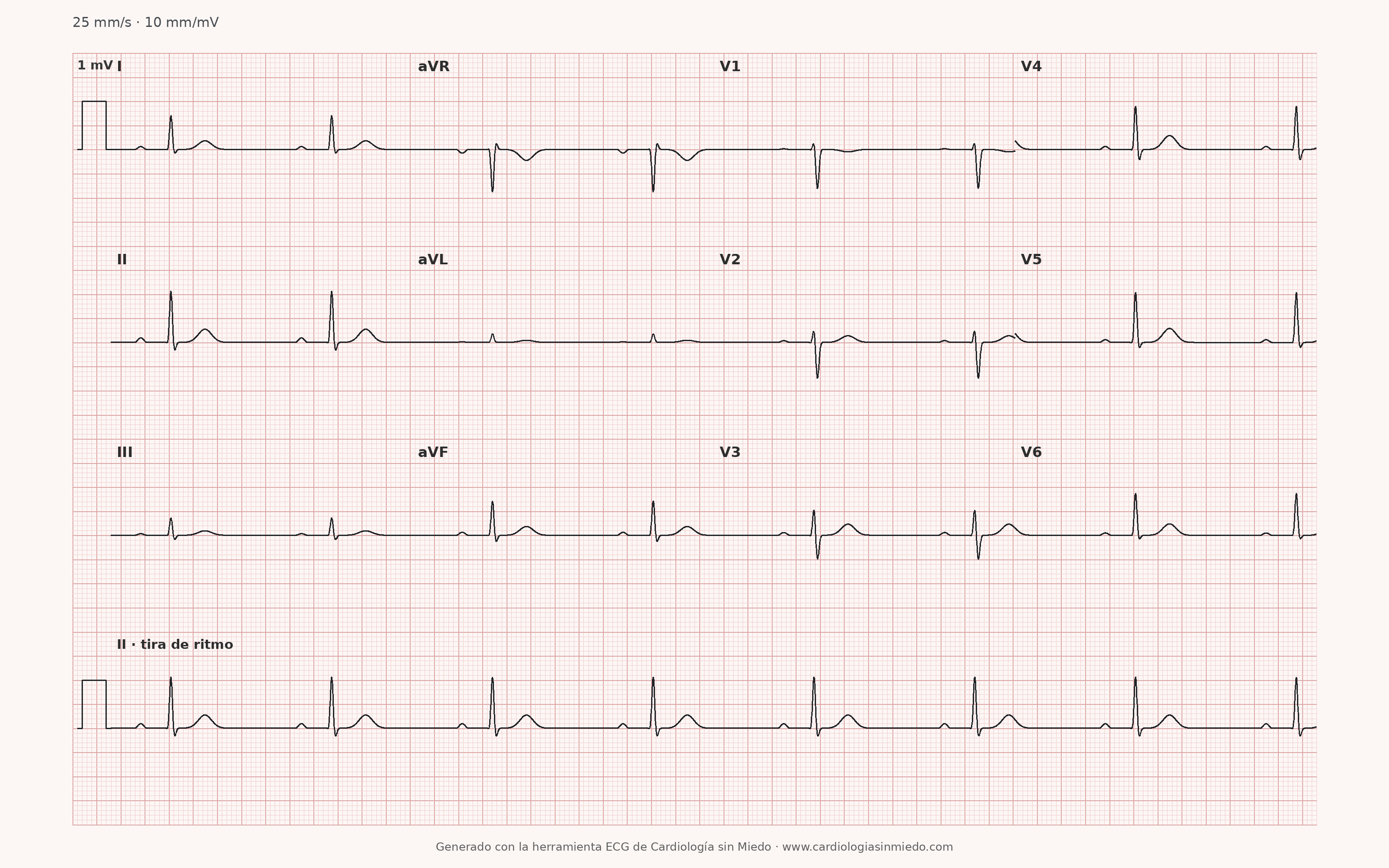 ECG de 12 derivaciones con bradicardia en un patrón docente asociado a hipermagnesemia, generado con el motor de Cardiología sin Miedo